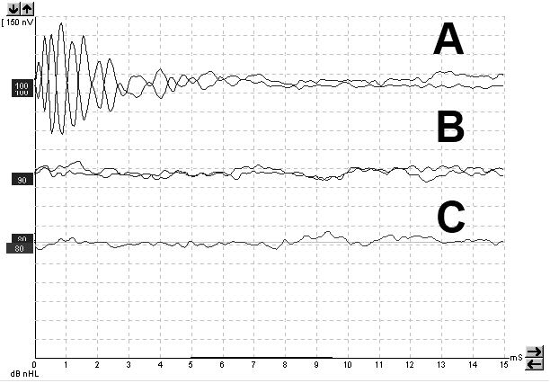 Рис. 1. Микрофонный потенциал у пациента со слуховой нейропатией (А). В и С – КСВП при предъявлении стимула альтернативной полярности.